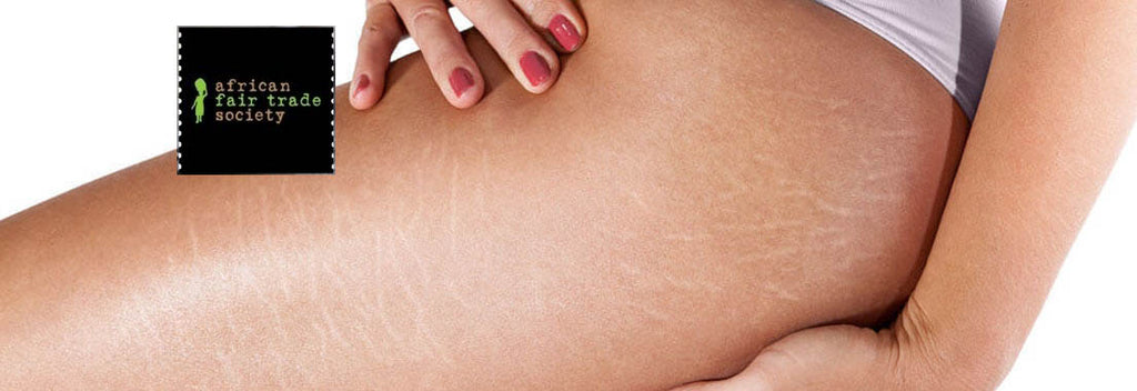 Is Shea Butter Helpful For Removing Stretch Marks- Know Here!