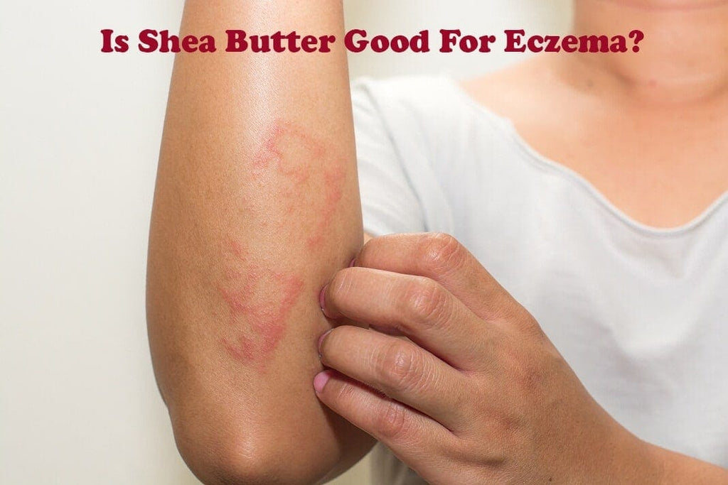 Is Shea Butter Good For Eczema?
