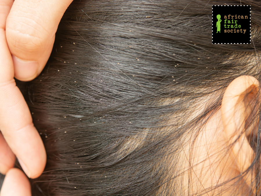 Eliminate Head Lice Safely with Soothing Shea Butter