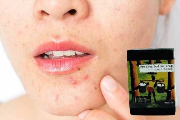 Should You Use African Black Soap to Get Rid of Acne and Itchy Skin?