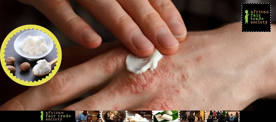Shea butter for eczema