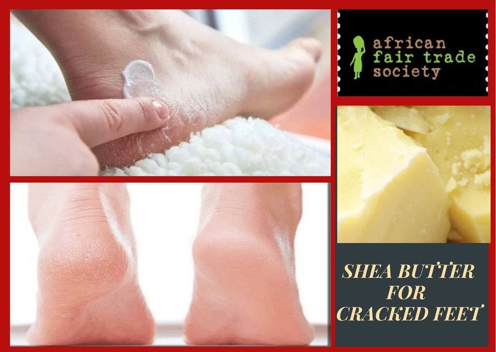 Struggling with Dry Cracked Heels? Shea Butter Can Help!