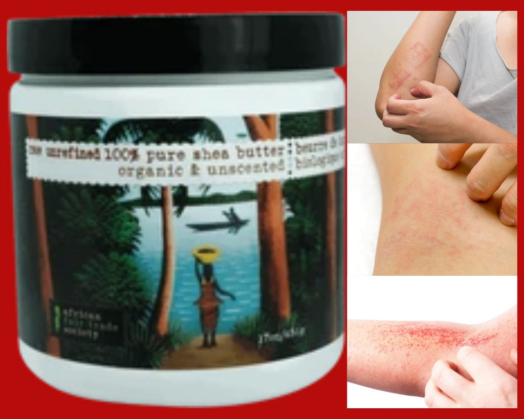 Explore the Skin Issues That Shea Butter Can Effectively Deal with